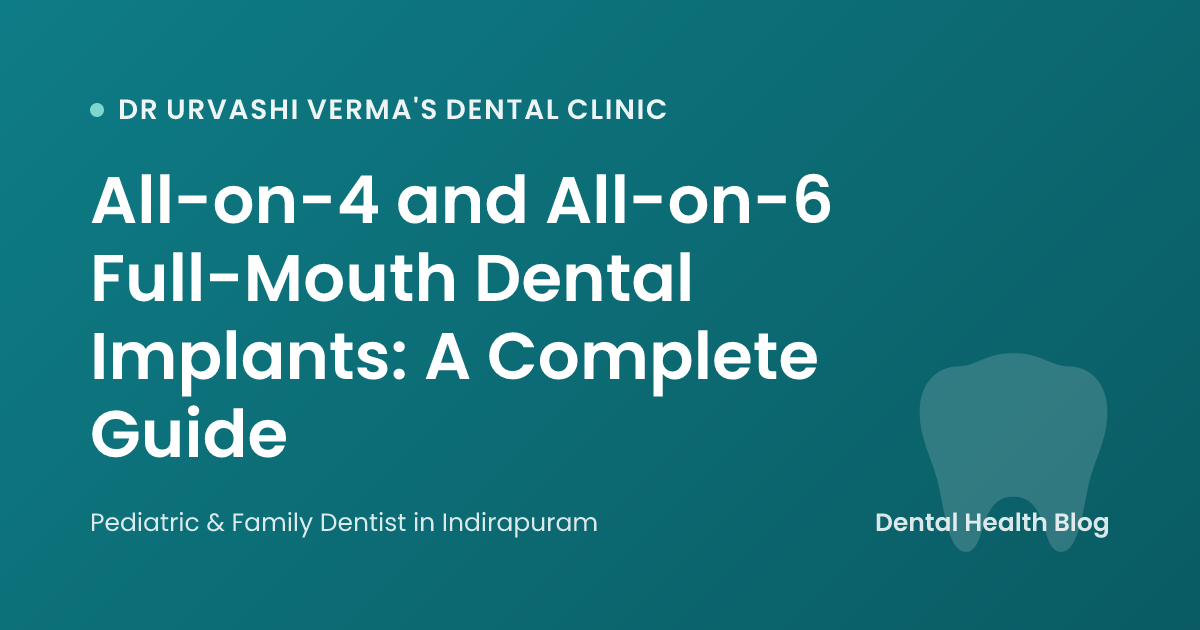 All-on-4 and All-on-6 Full-Mouth Dental Implants: A Complete Guide