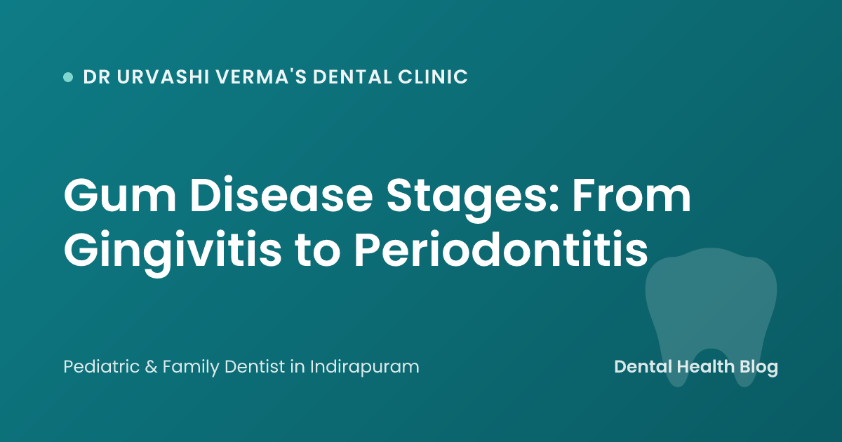 Gum Disease Stages: From Gingivitis to Periodontitis